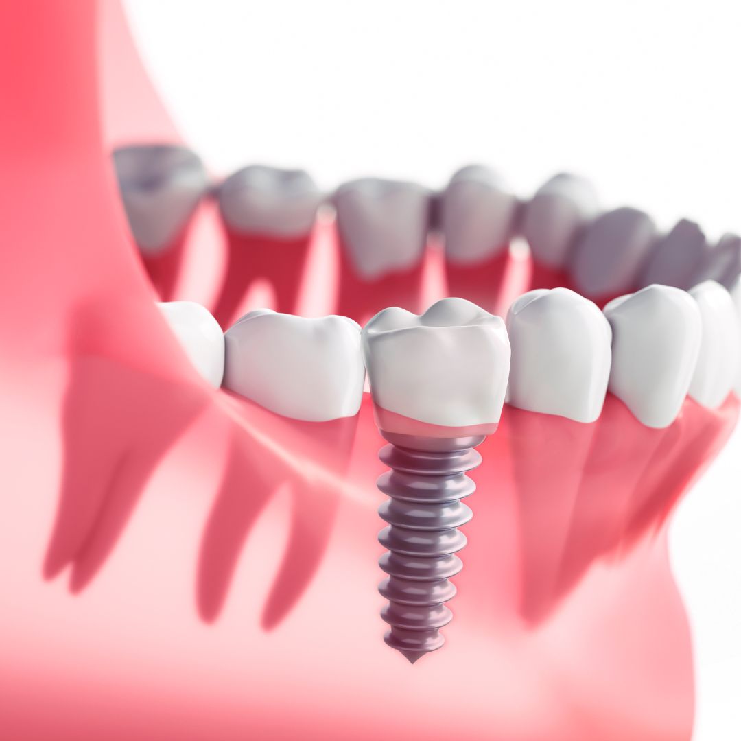implante dental