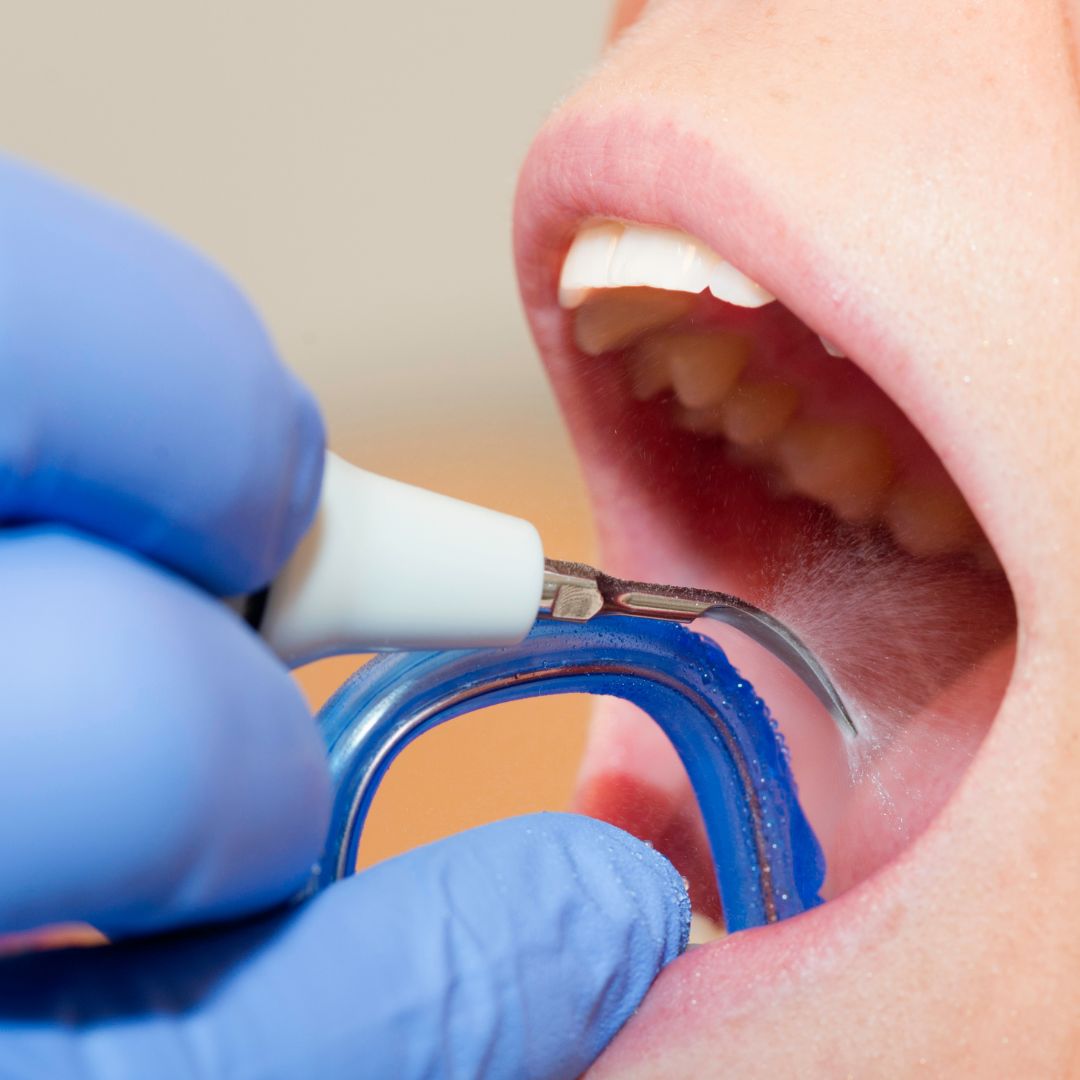 limpieza dental