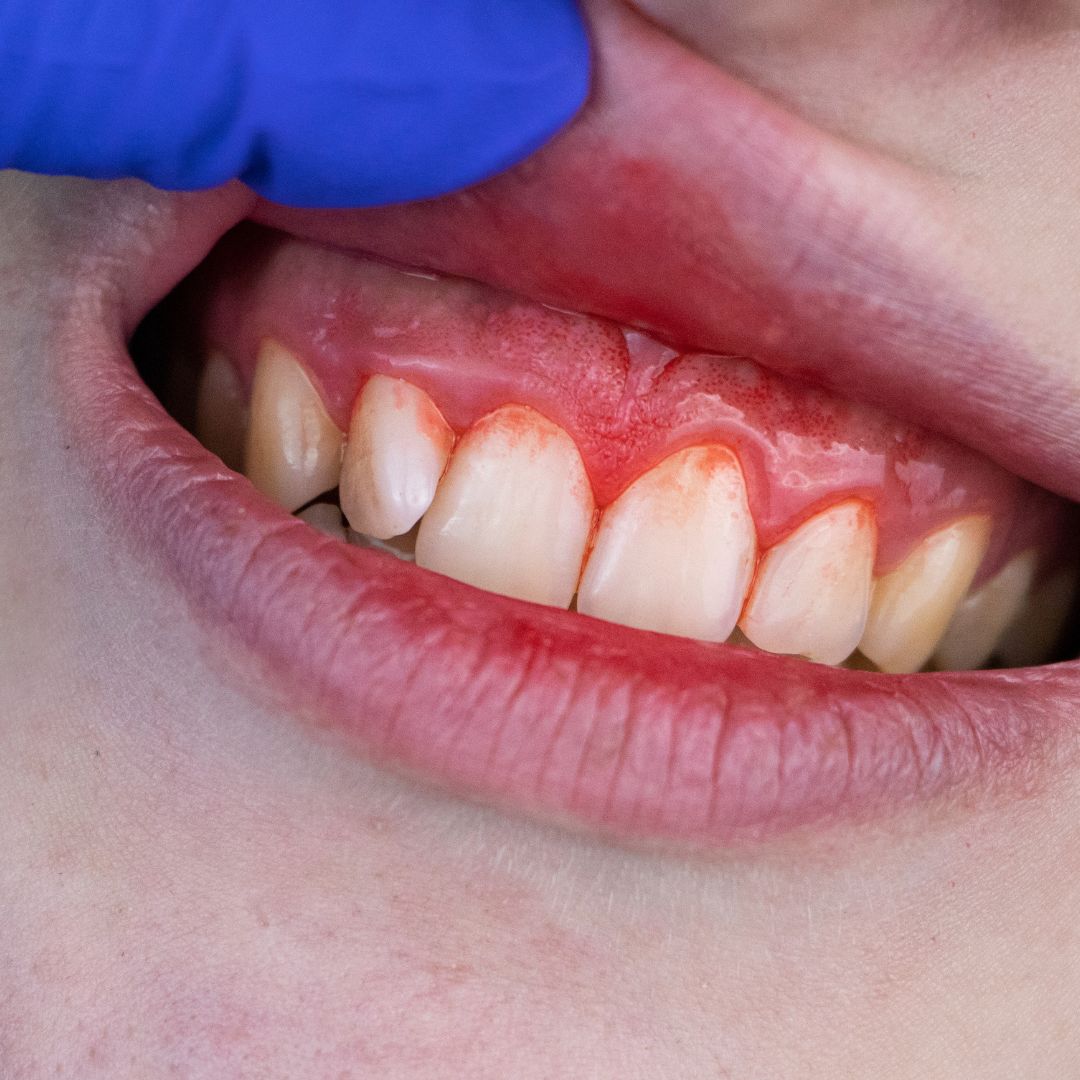 implante dental